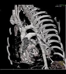 Mediastinal Hematoma - CTisus CT Scan