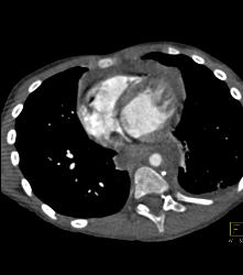 Mediastinal Hematoma - CTisus CT Scan