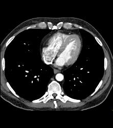 Incidental Pe - CTisus CT Scan