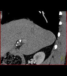 Incidental Pe - CTisus CT Scan