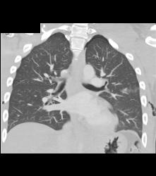 Repaired Aberrant Right Subclavian Artery - CTisus CT Scan