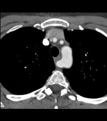 Repaired Aberrant Right Subclavian Artery - CTisus CT Scan