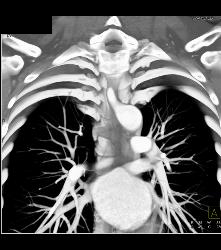 Repaired Aberrant Right Subclavian Artery - CTisus CT Scan