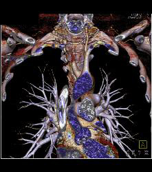 Repaired Aberrant Right Subclavian Artery - CTisus CT Scan