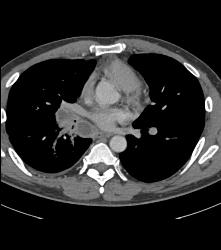 Metastatic Nodes From Renal Cell Carcinoma - CTisus CT Scan