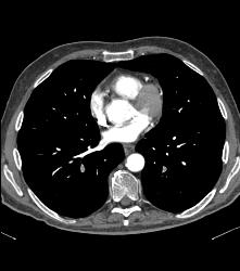 Incidental Pulmonary Embolism (PE) in Patient With Pancreatic Cancer - CTisus CT Scan