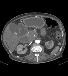 Incidental Pulmonary Embolism (PE) in Patient With Pancreatic Cancer - CTisus CT Scan