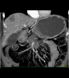 Incidental Pulmonary Embolism (PE) in Patient With Pancreatic Cancer - CTisus CT Scan