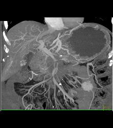 Incidental Pulmonary Embolism (PE) in Patient With Pancreatic Cancer - CTisus CT Scan