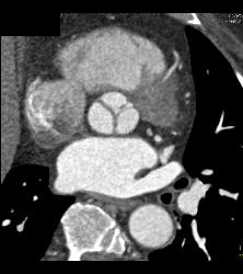 Thickened Aortic Valve - CTisus CT Scan