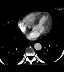 Pe - CTisus CT Scan