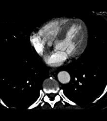 Pe - CTisus CT Scan