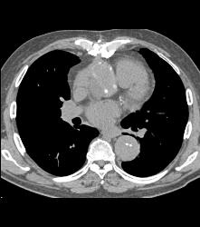 Aortic Dissection- See Full Sequence- With Displaced Calcium - CTisus CT Scan