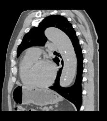 Aortic Dissection- See Full Sequence- With Displaced Calcium - CTisus CT Scan