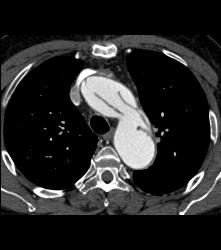 Aortic Dissection- See Full Sequence- With Displaced Calcium - CTisus CT Scan