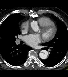 Aortic Dissection- See Full Sequence- With Displaced Calcium - CTisus CT Scan