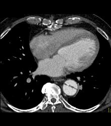 Aortic Dissection- See Full Sequence- With Displaced Calcium - CTisus CT Scan