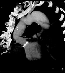 Aortic Dissection- See Full Sequence- With Displaced Calcium - CTisus CT Scan