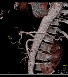 Aortic Dissection- See Full Sequence- With Displaced Calcium - CTisus CT Scan