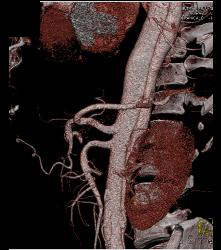 Aortic Dissection- See Full Sequence- With Displaced Calcium - CTisus CT Scan