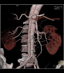 Aortic Dissection- See Full Sequence- With Displaced Calcium - CTisus CT Scan