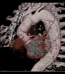 Aortic Dissection- See Full Sequence- With Displaced Calcium - CTisus CT Scan