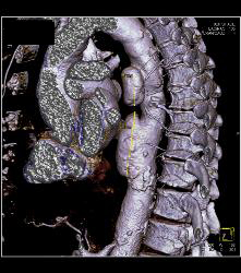 Ulcerations in Descending Thoracic Aorta - CTisus CT Scan