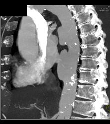 Ulcerations in Descending Thoracic Aorta - CTisus CT Scan