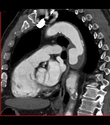 Ulcerations in Descending Thoracic Aorta - CTisus CT Scan