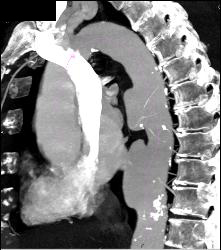 Ulcerations in Descending Thoracic Aorta - CTisus CT Scan