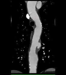 Ulcerations in Descending Thoracic Aorta - CTisus CT Scan