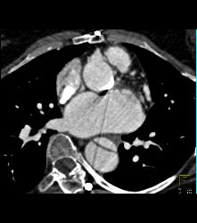 Aortic Dissection - CTisus CT Scan