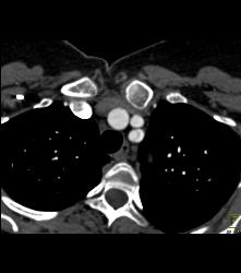 Aortic Dissection - CTisus CT Scan