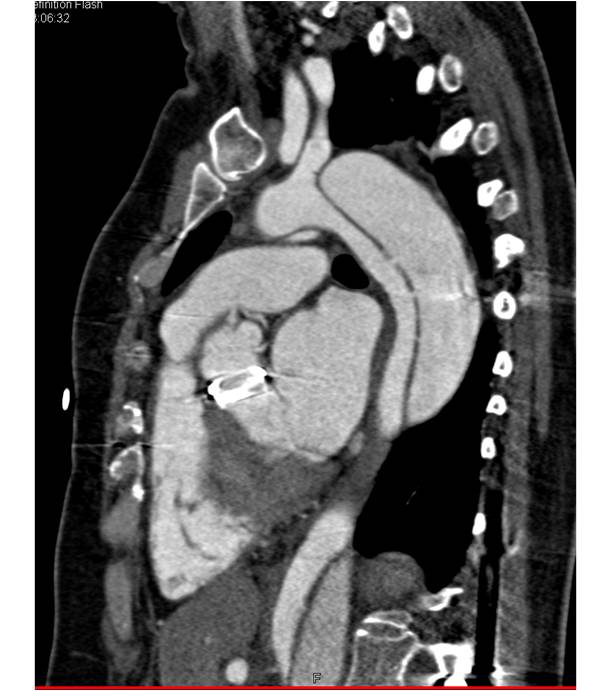 Type-A Dissection with Root Repair and Aortic Valve Replacement (AVR). Dissection extent in abdominal aorta noted - CTisus CT Scan