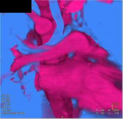 Right Aortic Arch with Almost Double Arch - CTisus CT Scan