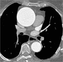 Dilated Aortic Root and Ascending Aorta - CTisus CT Scan