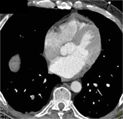 Aortic Dissection with Endovascular Stent Repair and Incidental PE - CTisus CT Scan