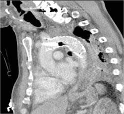 Repair of Coarctation of the Aorta with Endovascular Stent - CTisus CT Scan