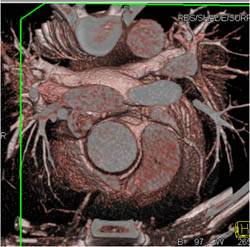 Aberrant Right Coronary Artery off the Left Cusp - CTisus CT Scan