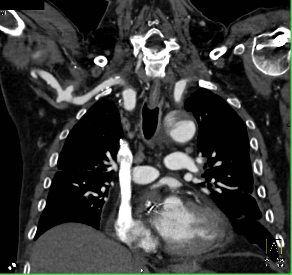 Traumatic Aneurysm of Right Axillary Artery on CTA - CTisus CT Scan