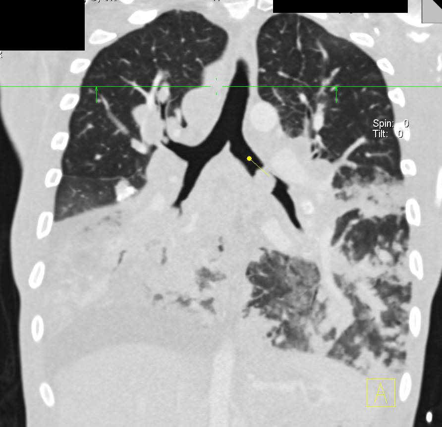 Metastatic Renal Cell Carcinoma to Left Mainstem Bronchus. Lun Parenchyma and Mediastinum - CTisus CT Scan