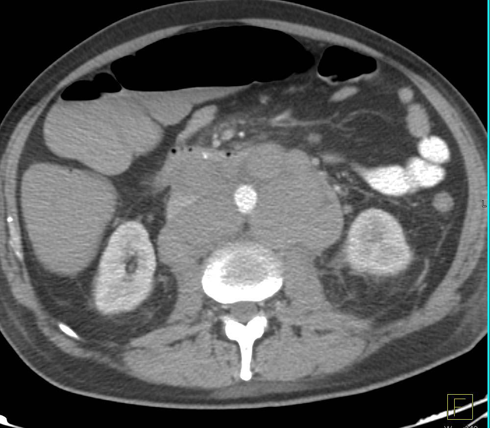 Lymphoma With Adenopathy In Neck Chest And Abdomen Chest Case