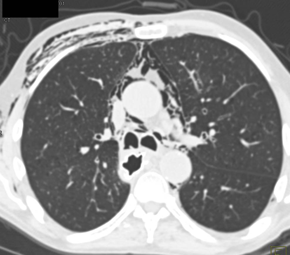 Pneumomediastinum - CTisus CT Scan