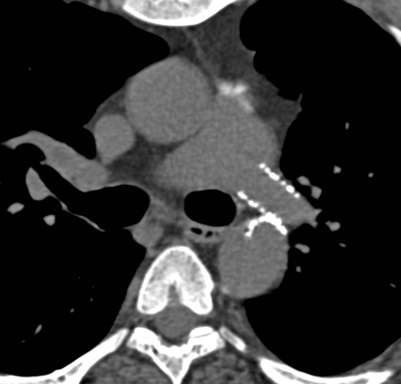 Coarctation of the Aorta with Bicuspid Valve and Stents in the Aorta and Right Pulmonary Artery - CTisus CT Scan