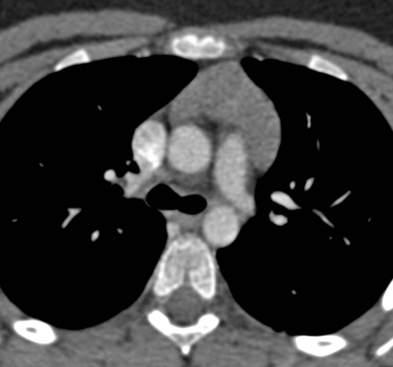 Normal Thymus in a 20 Year Old - Chest Case Studies - CTisus CT Scanning