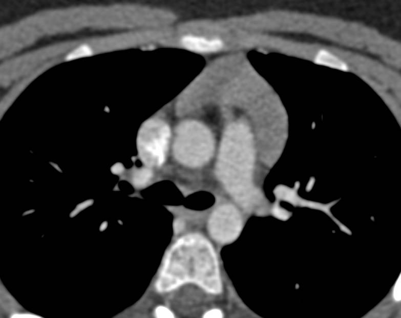 Normal Thymus in a 20 Year Old - Chest Case Studies - CTisus CT Scanning