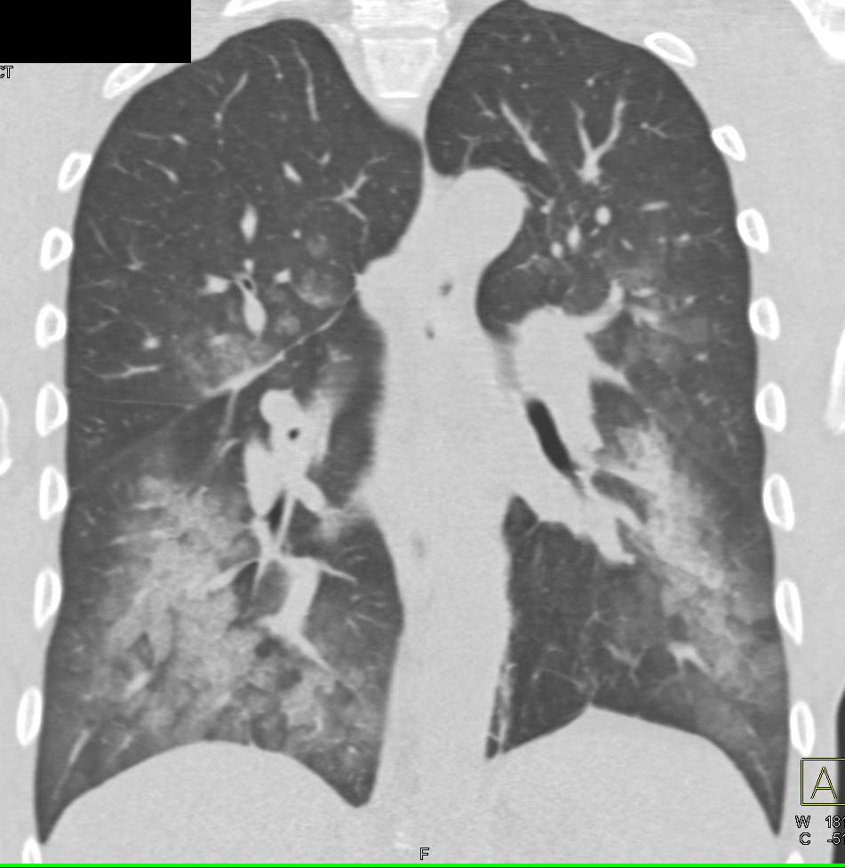 Pulmonary Hemorrhage - CTisus CT Scan