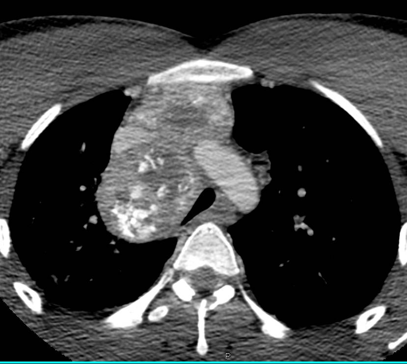 Metastatic Osteosarcoma to the Chest - CTisus CT Scan