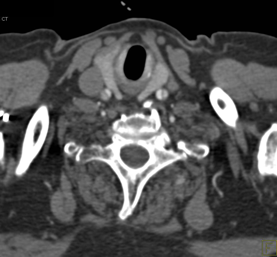 Type A Dissection Extending into the Abdominal Aorta as well as Carotid Arteries - CTisus CT Scan