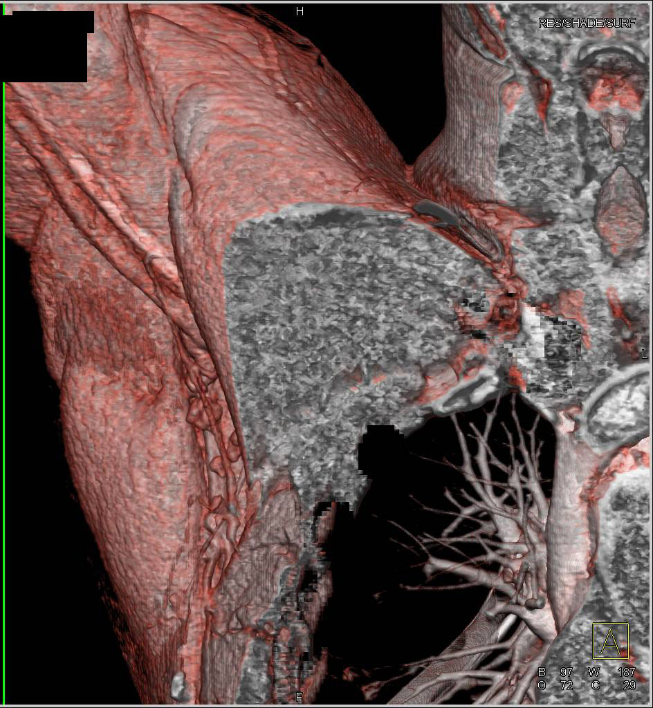 Patent Axillary Artery Following Trauma - CTisus CT Scan
